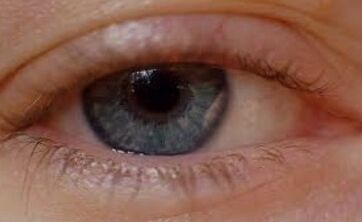Oculax-szal gyógyított blepharitis
